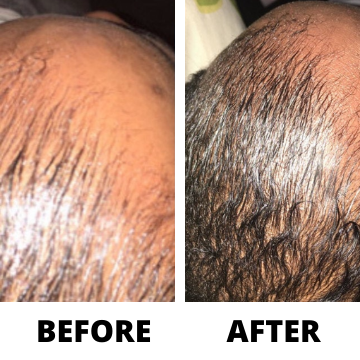 Get Three Bottles of Rennora EXTRA-Strength Hair Growth Serum